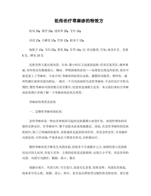 急性荨麻疹祖传药方