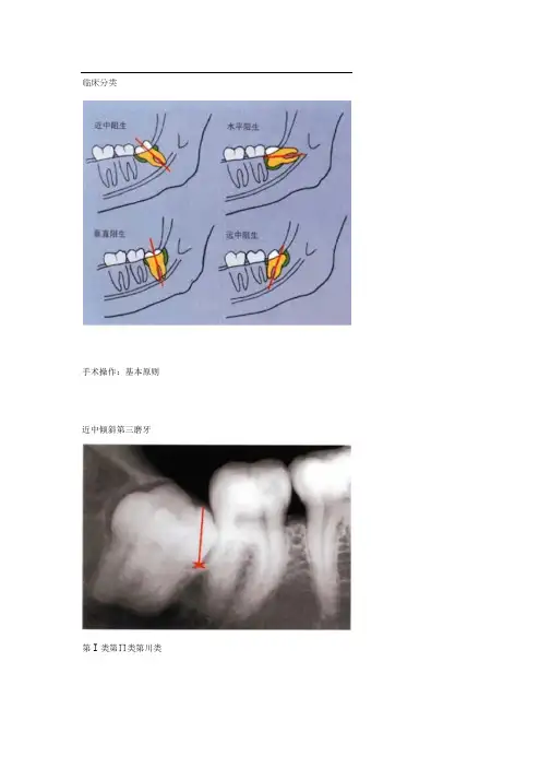 拔牙技巧图解