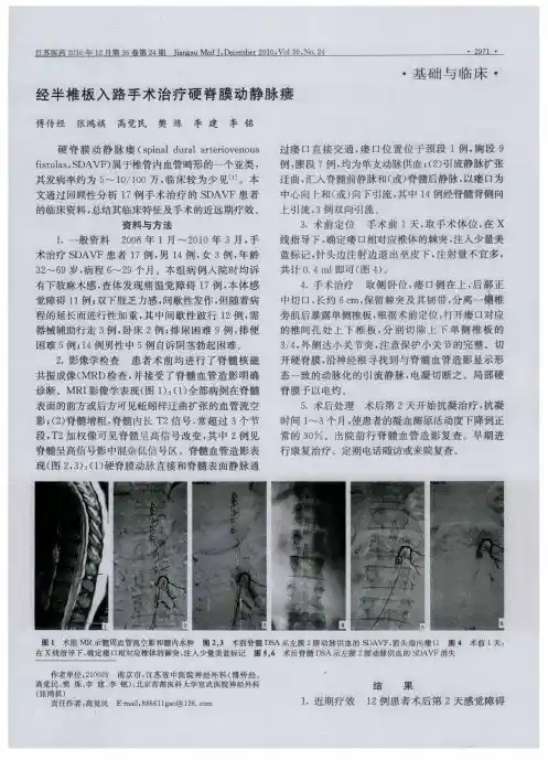 经半椎板入路手术治疗硬脊膜动静脉瘘