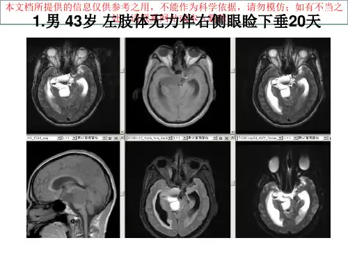 垂体瘤的MR诊疗和鉴别诊疗培训课件