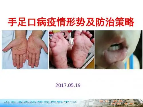 手足口病疫情形势及防治策略医疗救治视频培训会议PPT课件