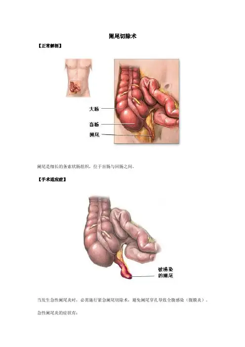阑尾切除术