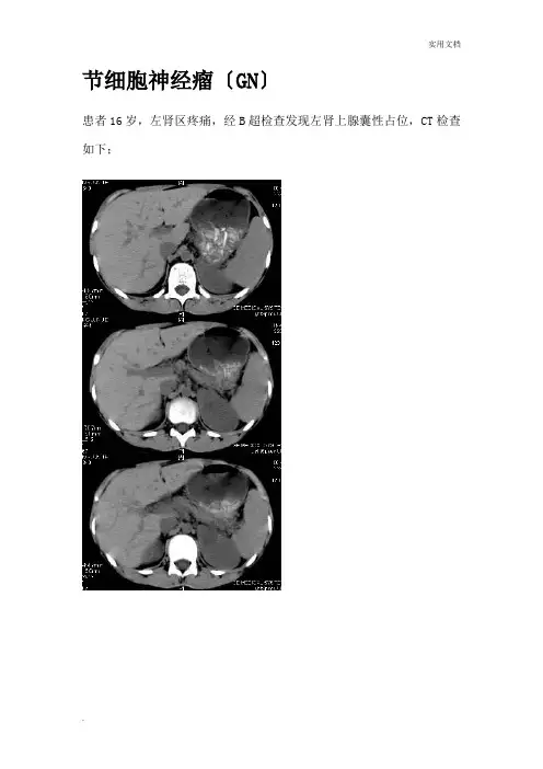 节细胞神经瘤