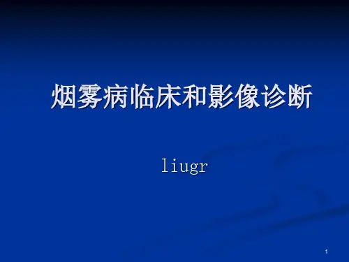 烟雾病影像诊断PPT