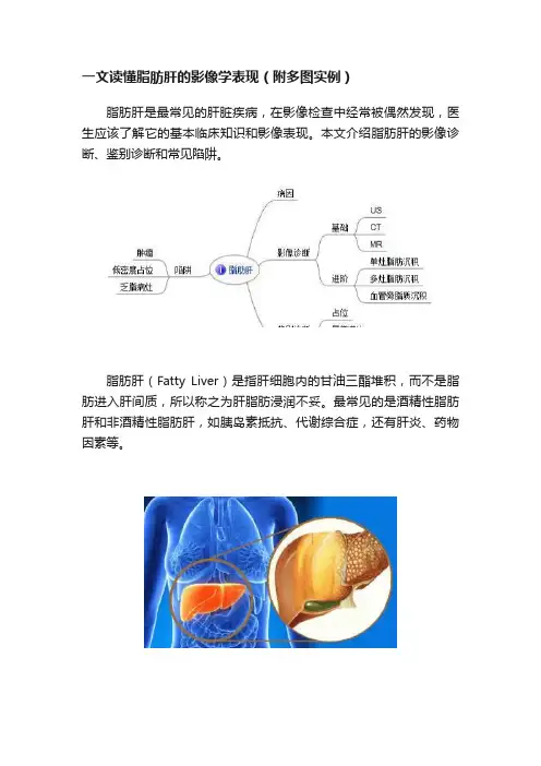 一文读懂脂肪肝的影像学表现（附多图实例）