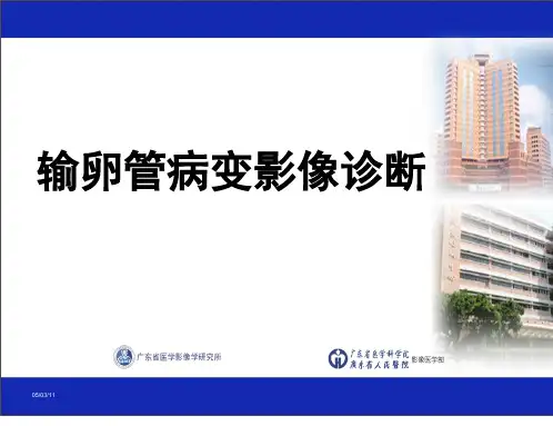 输卵管病变影像诊断PPT演示幻灯片