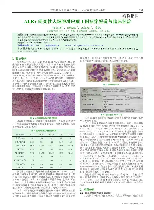 ALK+间变性大细胞淋巴瘤1例病案报道与临床经验