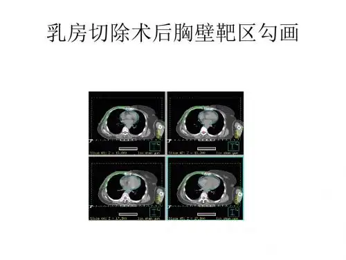 乳腺癌靶区勾画