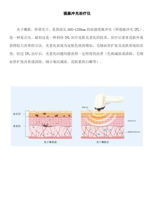 强脉冲光治疗仪宣传介绍