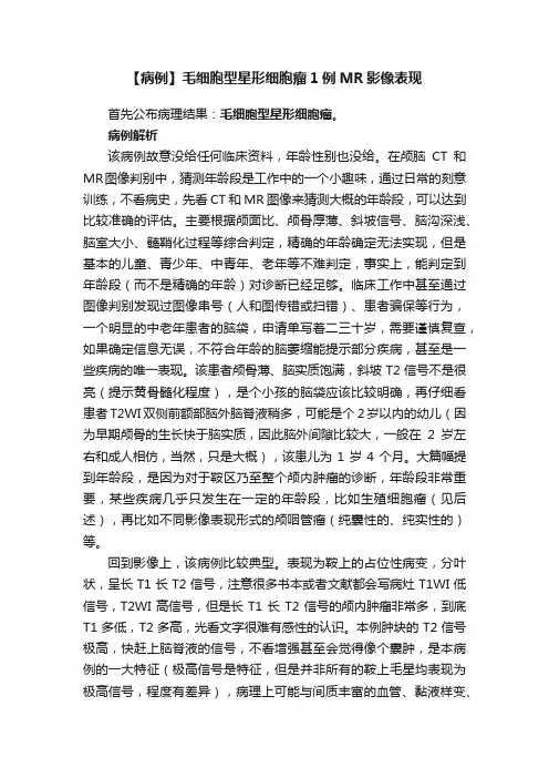 【病例】毛细胞型星形细胞瘤1例MR影像表现