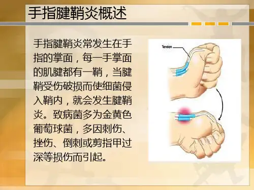 手指腱鞘炎最佳治疗方法