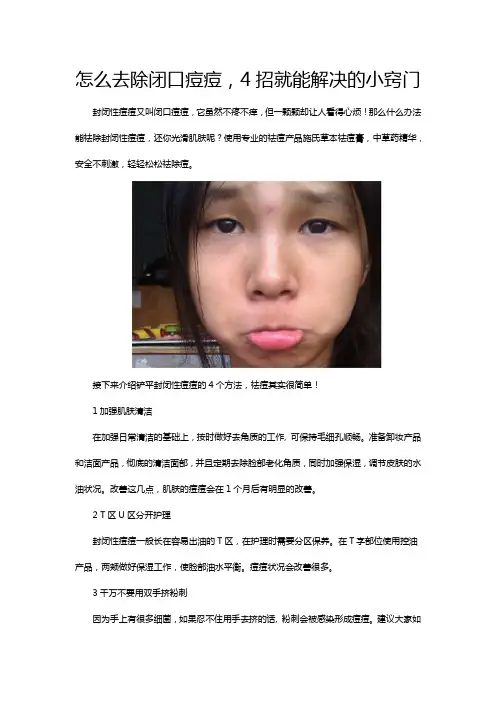 怎么去除闭口痘痘,4招就能解决的小窍门