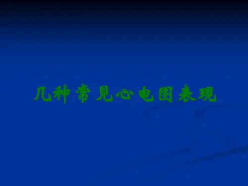 几种常见心电图表现