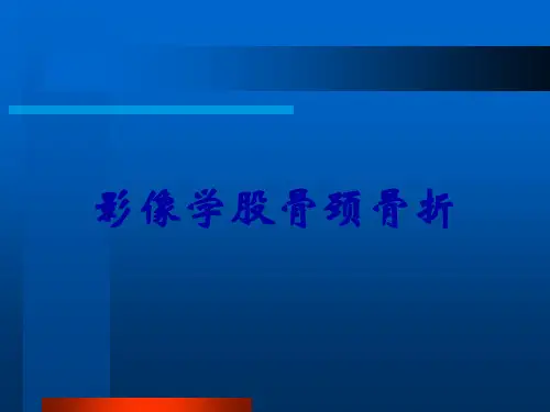 影像学股骨颈骨折