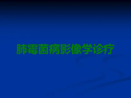 肺霉菌病影像学诊疗