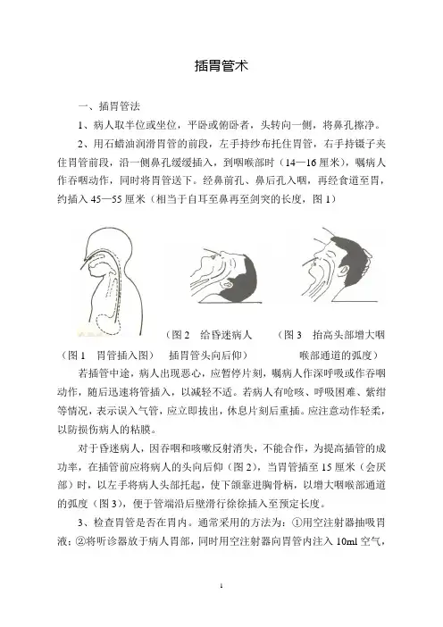 插胃管术