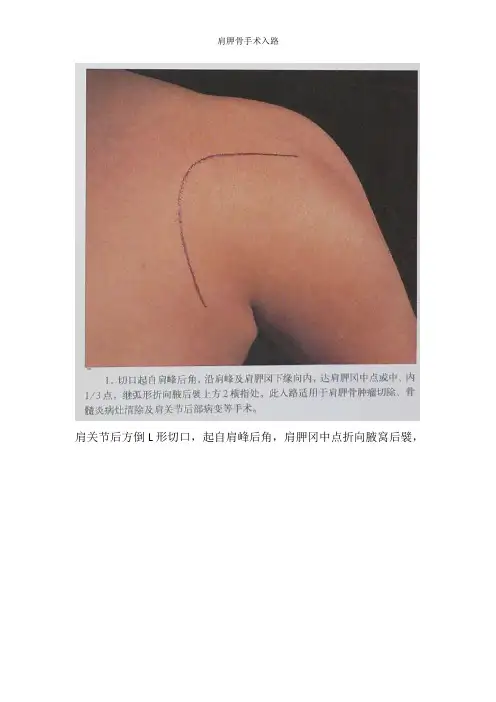 肩胛骨手术入路