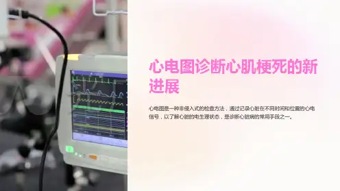 心电图诊断心肌梗死的新进展