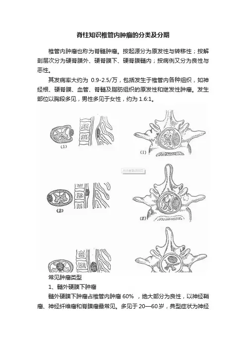 脊柱知识椎管内肿瘤的分类及分期