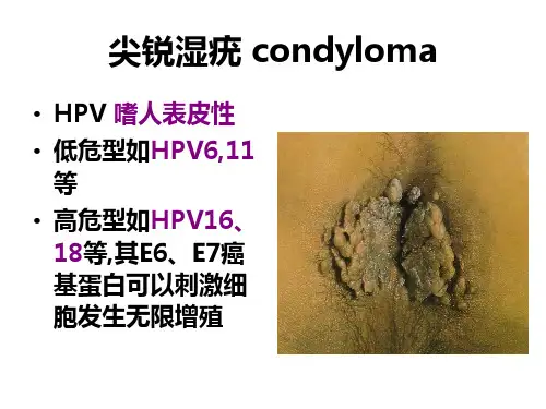 皮肤性病学：尖锐湿疣 condyloma