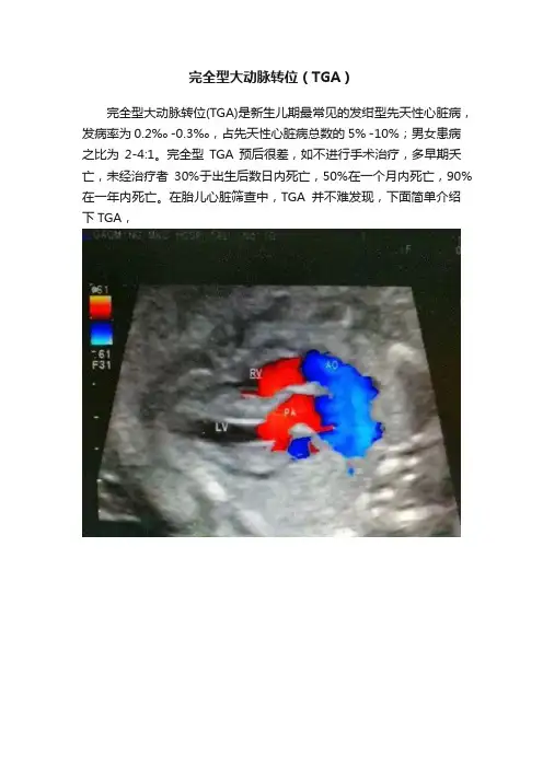 完全型大动脉转位（TGA）