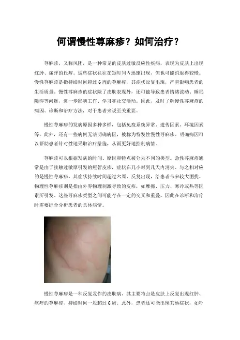 何谓慢性荨麻疹？如何治疗？