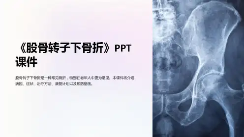 《股骨转子下骨折》课件