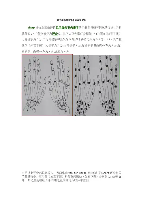类风湿关节炎Sharp评分