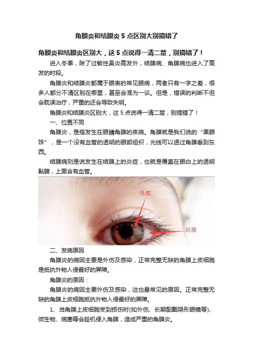 角膜炎和结膜炎5点区别大别搞错了