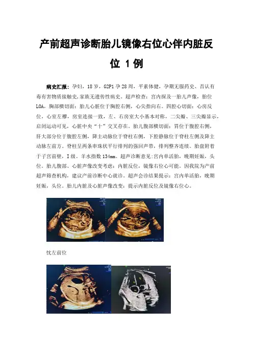产前超声诊断胎儿镜像右位心伴内脏反位1例