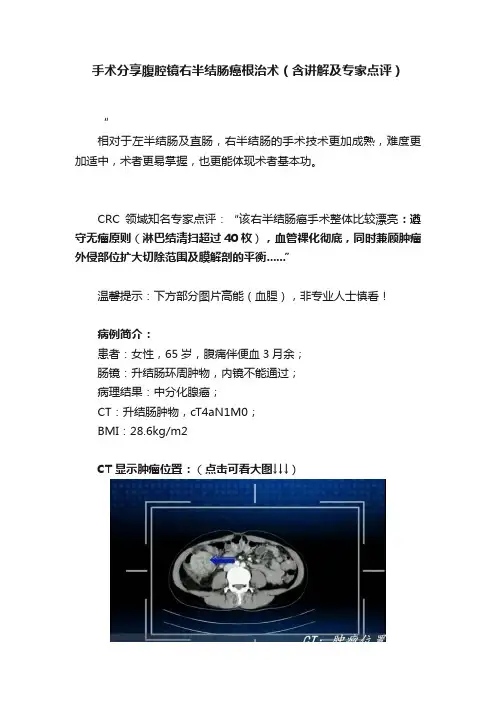 手术分享腹腔镜右半结肠癌根治术（含讲解及专家点评）