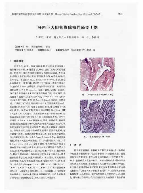 肝内巨大胆管囊腺瘤伴癌变1例