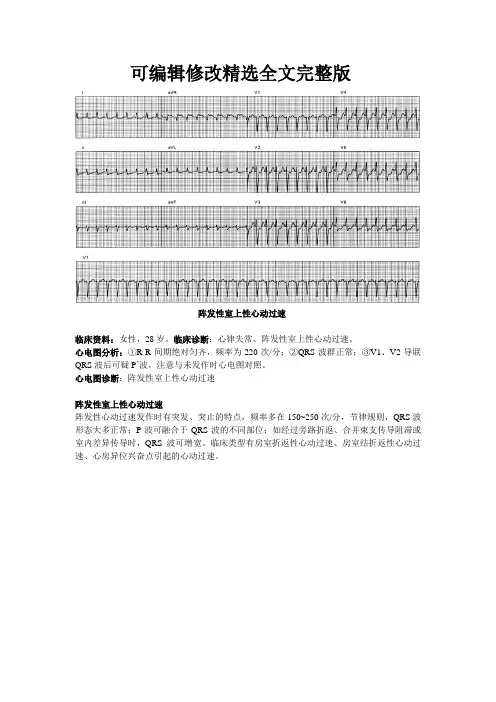 心电图--室上性心动过速精选全文完整版