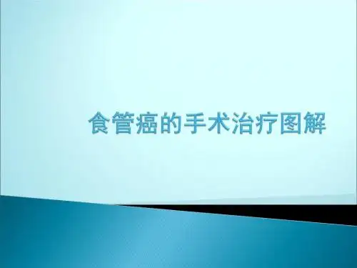 食管癌的手术治疗图解ppt课件