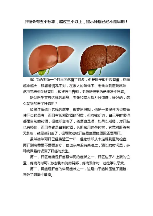 肝癌会有五个标志，超过三个以上，提示肿瘤已经不是早期！