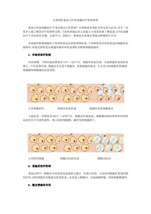 全面剖析氩氦刀冷冻消融治疗机制原理