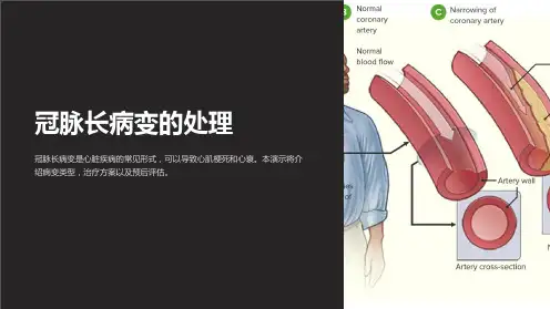 冠脉长病变的处理