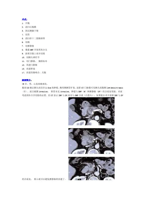 胰十二指肠切除术