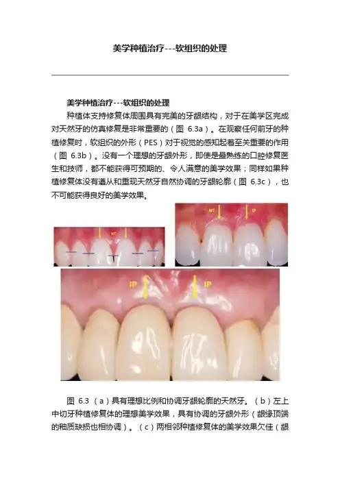 美学种植治疗---软组织的处理