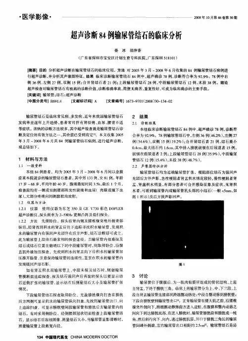 超声诊断84例输尿管结石的临床分析