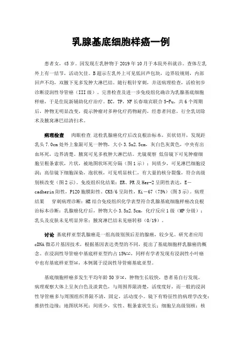 乳腺基底细胞样癌一例