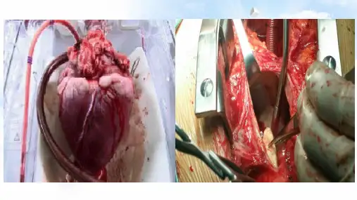 第二十一章体外循环和体外膜肺氧合教学课件
