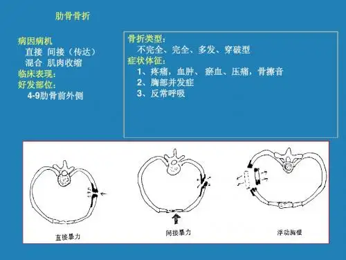 第四节 躯干骨折