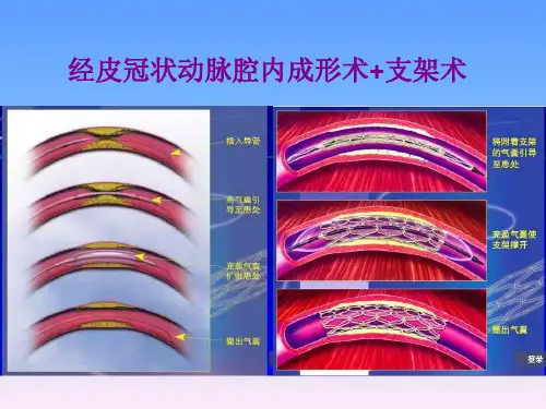 经皮冠状动脉腔内成形术(PTCA)