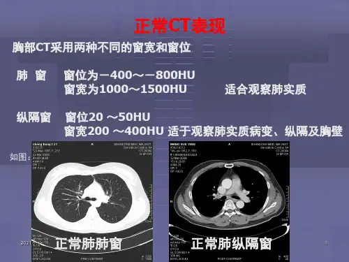 正常胸肺部CT