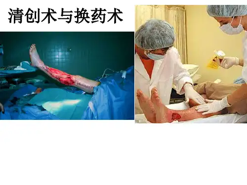 清创术 PPT课件