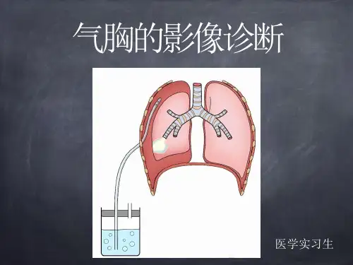 气胸的影像诊断