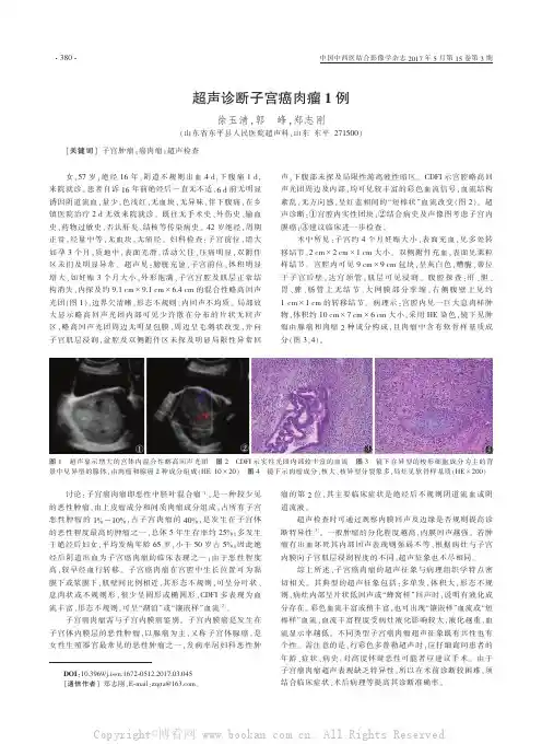 超声诊断子宫癌肉瘤1例