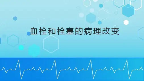 血栓和栓塞的病理改变