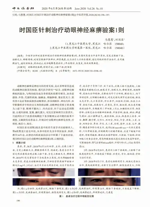 时国臣针刺治疗动眼神经麻痹验案1则